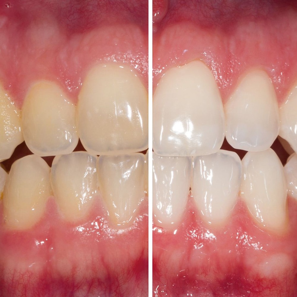 Fotografías de blanqueamiento dental