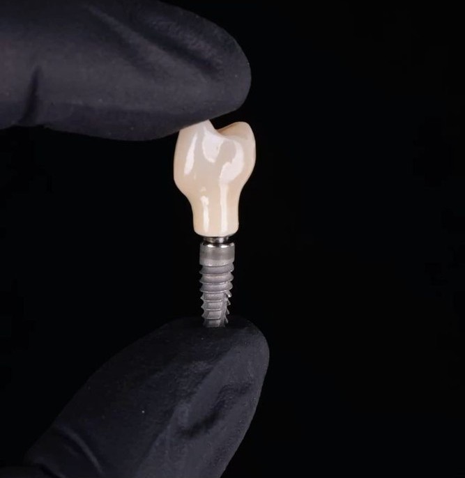 Implante dental con corona